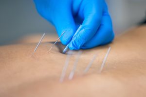 Igłoterapia sucha a odma opłucnowa. Jak udowodnić zachowanie należytej staranności przed ubezpieczycielem?